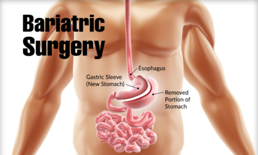 Bariatric surgery diagram e1551367451904