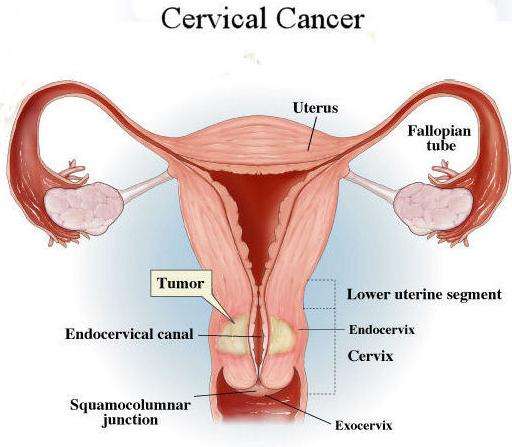 Cervical Cancer