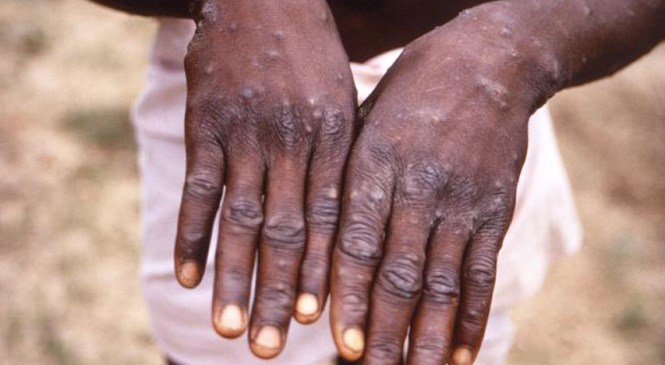 Monkey pox puts Nigeria in danger