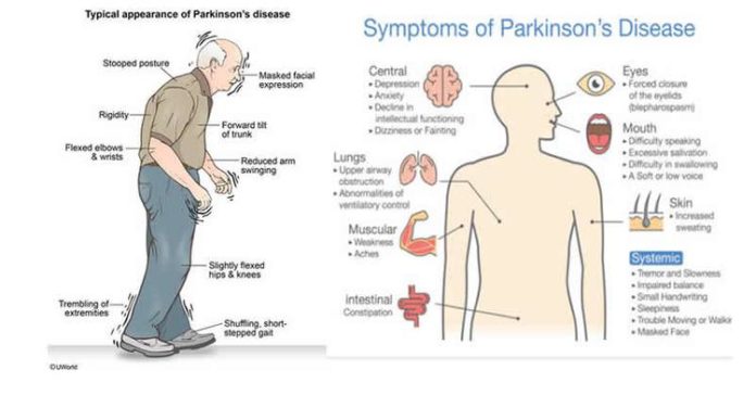 Parkinsons Disease 696x364