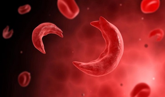 Sickle Cell Disease