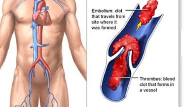 Thrombus