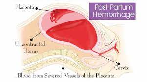 blood loss