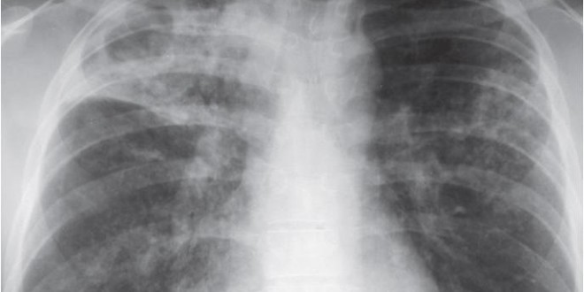 chest xray 660x330