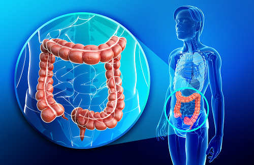 colon cancer