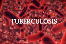 covid 19 worsens TB