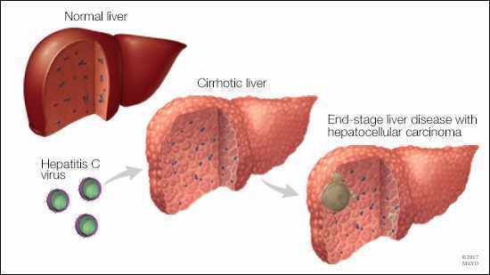 hepatitisC 16 x 9