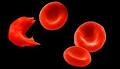 sickle cell