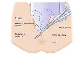 suturing