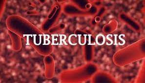 tuberculosis