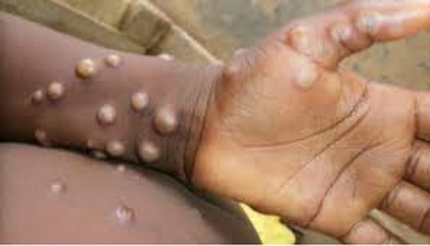 Monkeypox can be transmitted through kissing, hugging, expert says