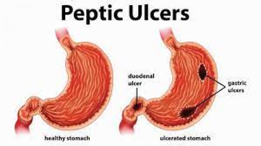 Scientist decries neglect of pathogen that causes peptic ulcer