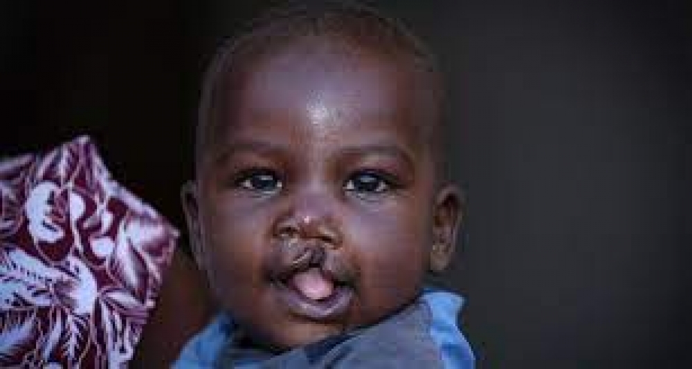 Using herbal, over-the-counter malaria medications while pregnant may cause cleft lips in babies – Physician