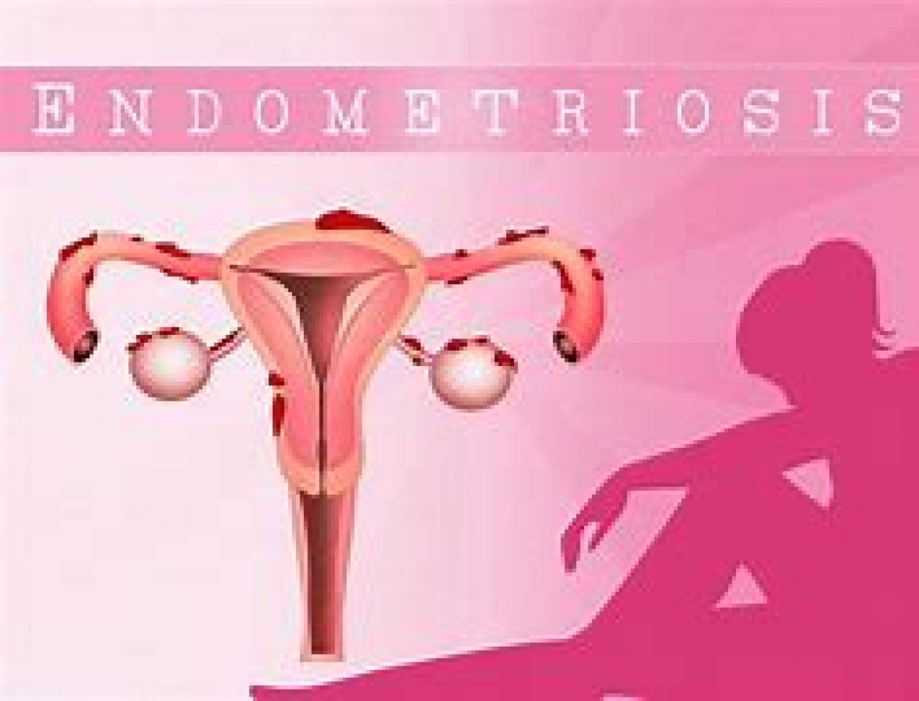 Late detection of endometriosis may reduce success of fertility treatment –Study