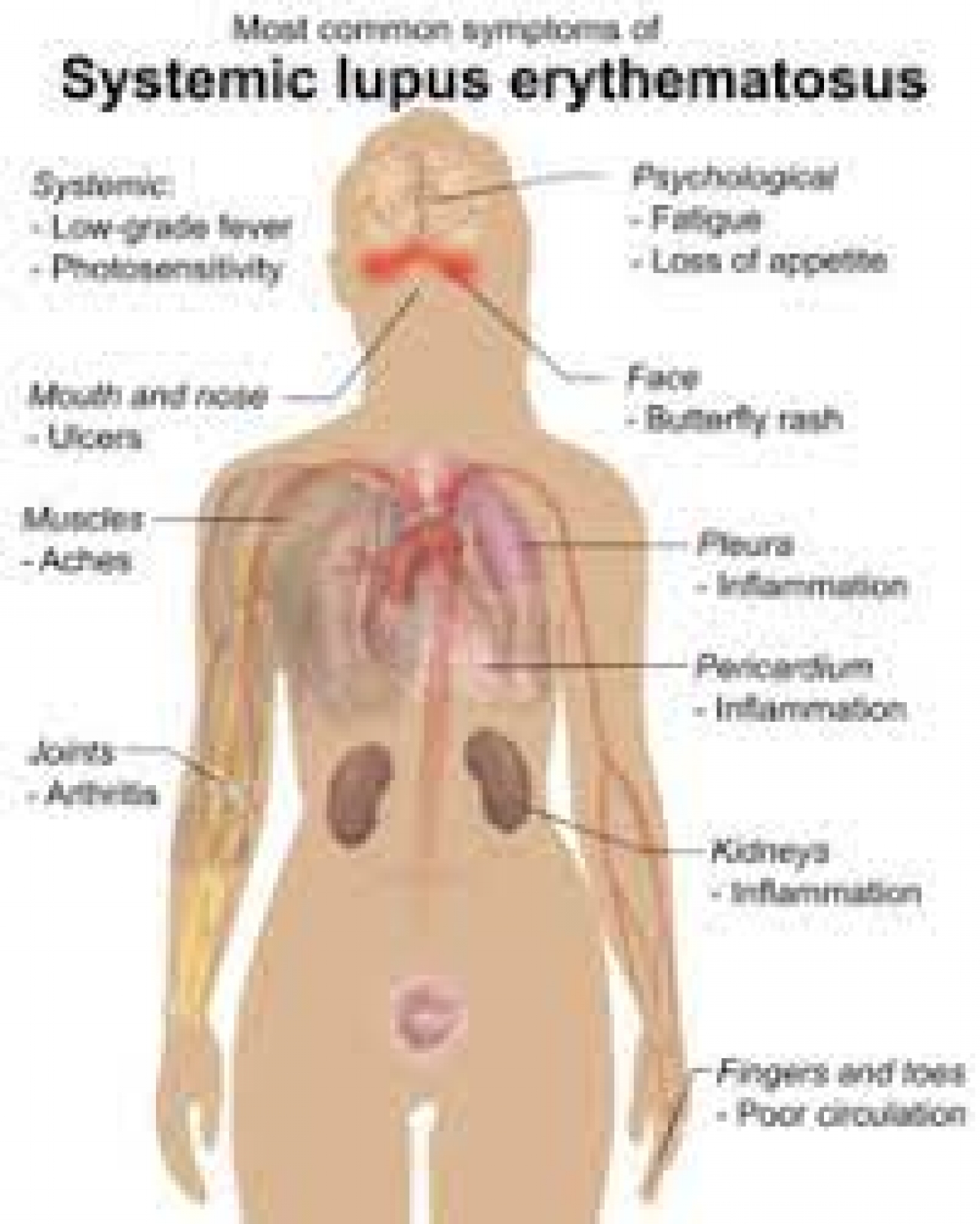 Most lupus patients live long -Rheumatologist