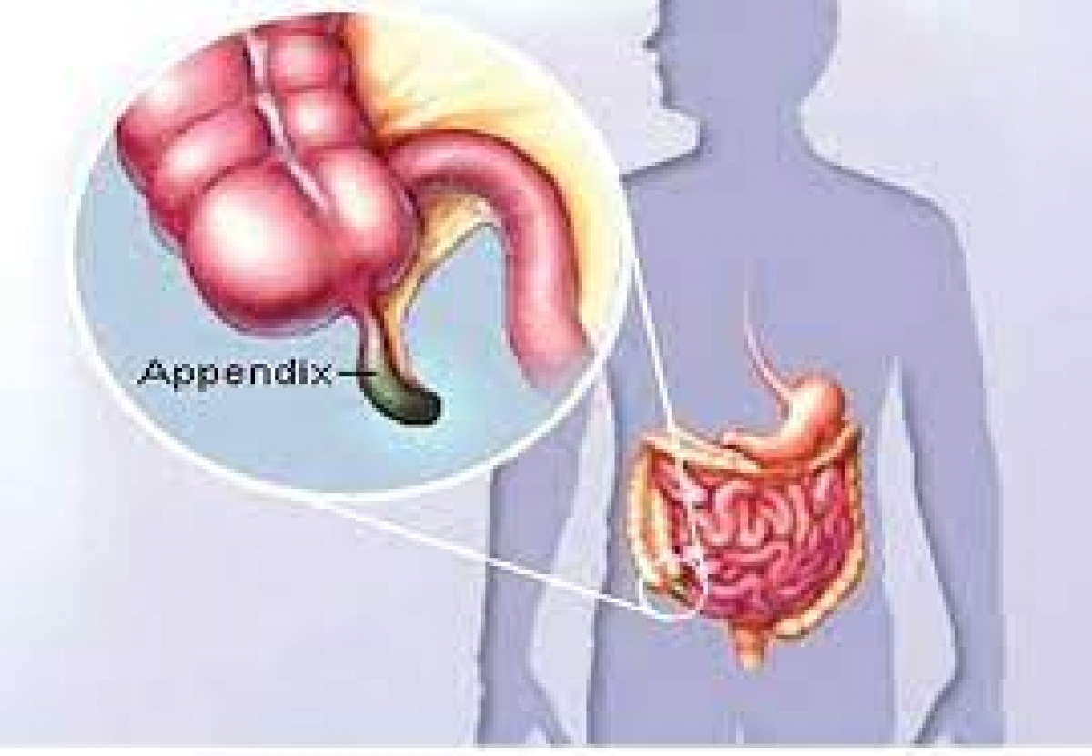 Voluntary removal of appendix is dangerous – Surgery experts