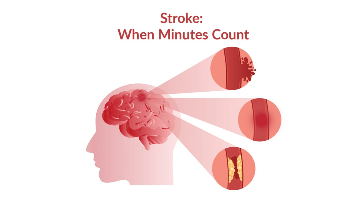 Stroke: When Minutes Count