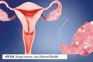 Why women with polycystic ovarian syndrome suffer psychological trauma –Gynaecologists