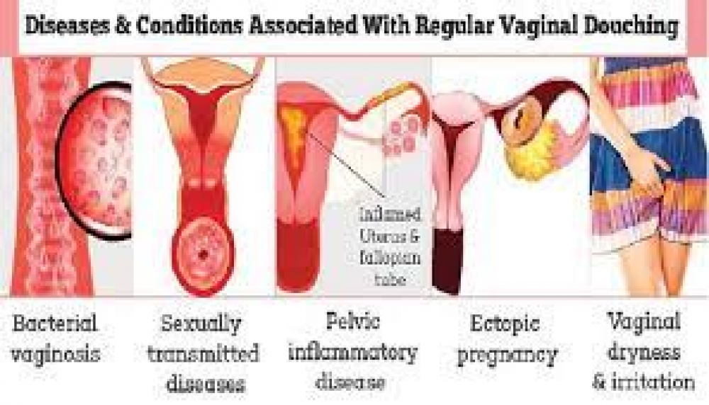 Douching impacts negatively on vagina acidity, creates environment for STIs, other diseases – Medical experts
