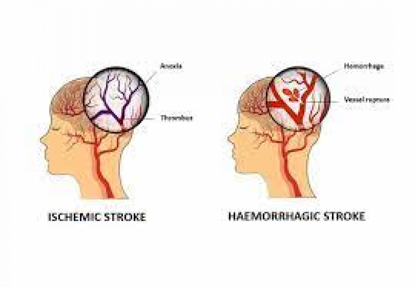 Why women may have different stroke risk factors, symptoms –Neurologists