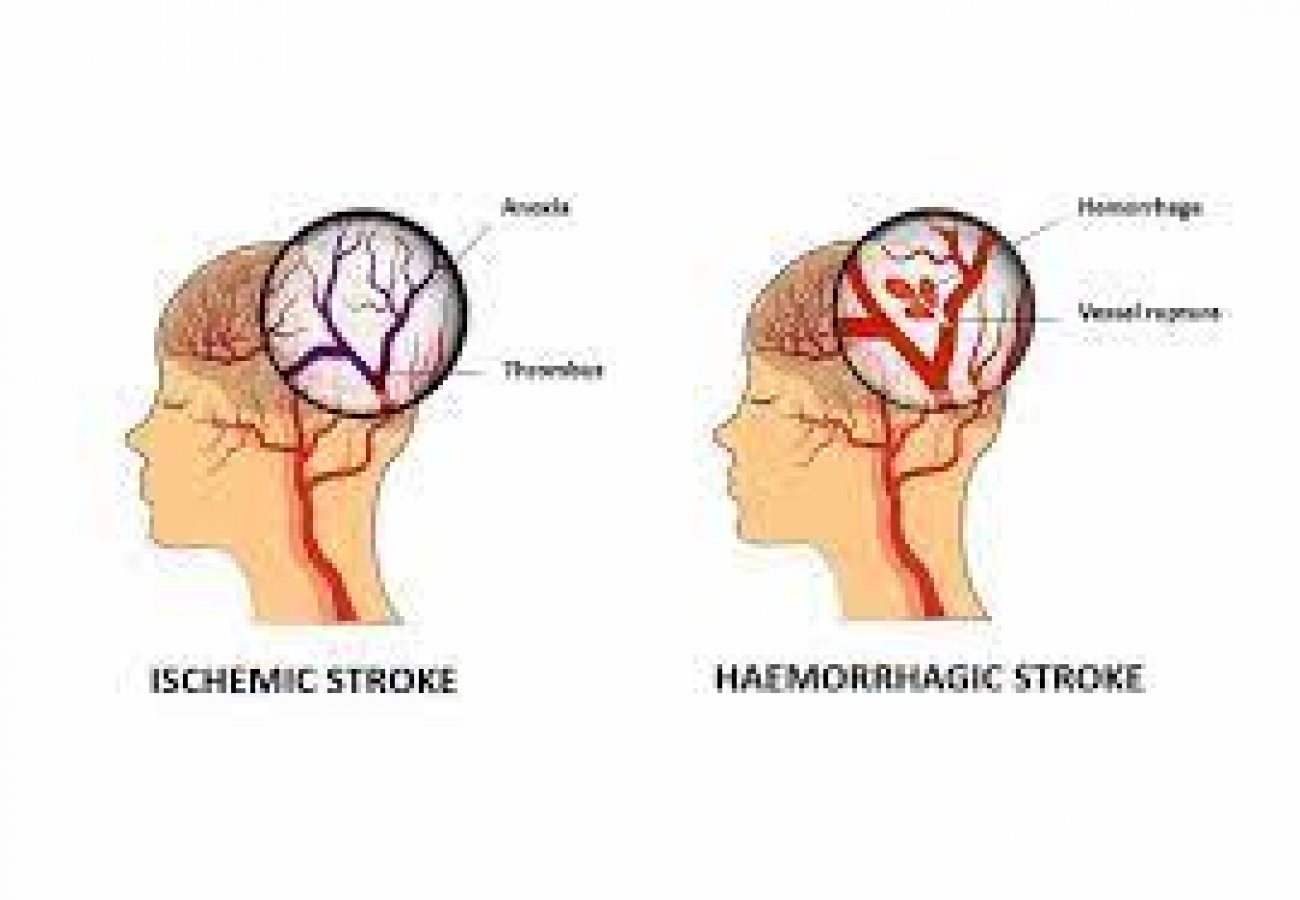 Why women may have different stroke risk factors, symptoms –Neurologists