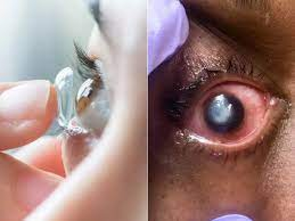 Improper use of contact lenses can cause conjunctivitis, expert warns