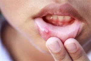 Oral sores, blisters symptom of herpes, not malaria –Microbiologist