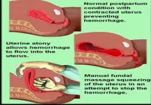 ‘Tackling postpartum hemorrhage can help reduce maternal mortality’