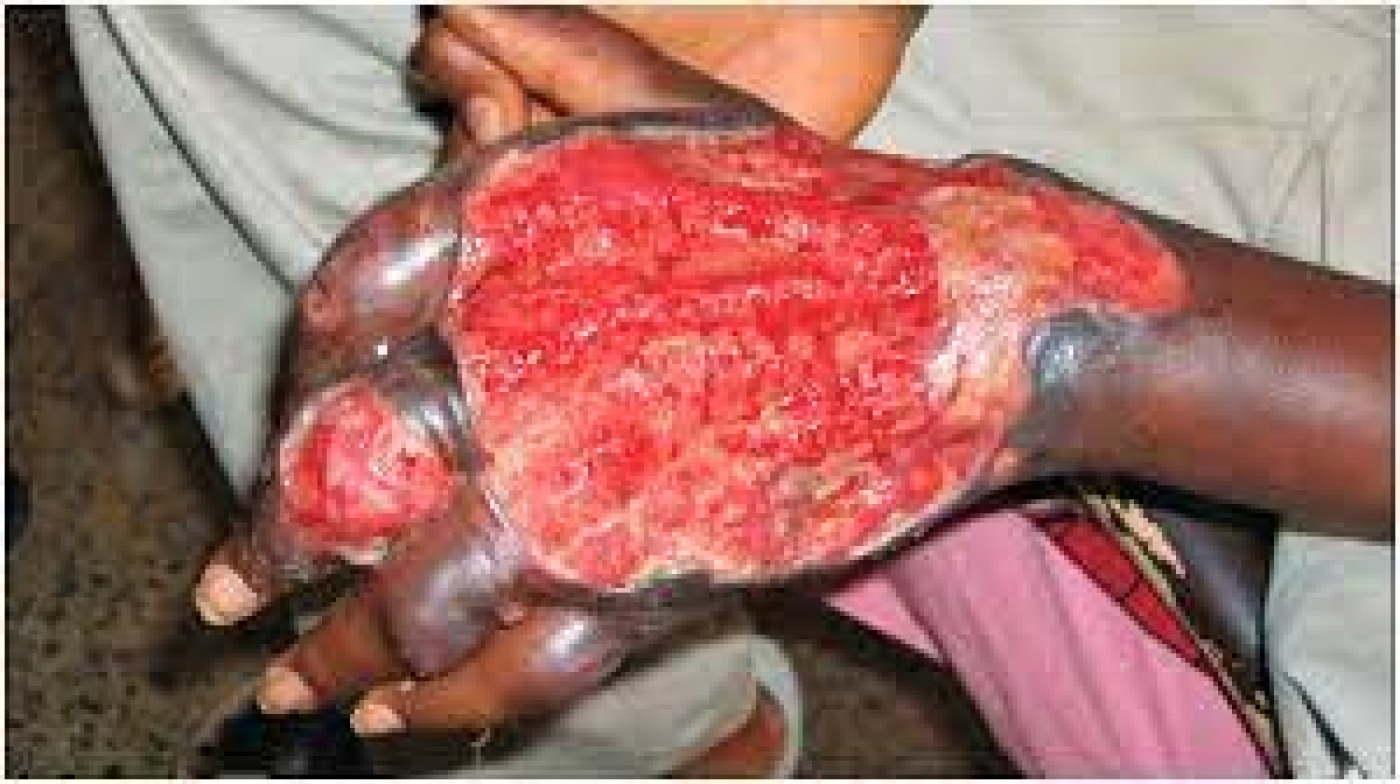 ‘Buruli ulcer third most common mycobacterial disease in Nigeria’