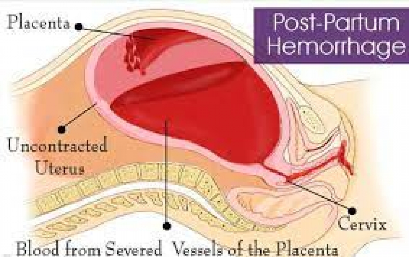 Attempt to reverse abortion in progress can cause heavy bleeding, birth defects –Experts