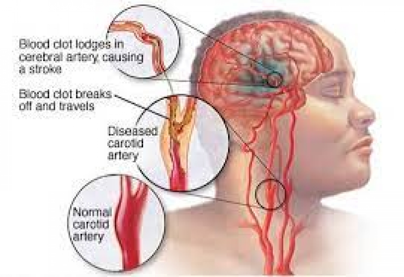 Cardiologists List 10 Means of Stroke Prevention