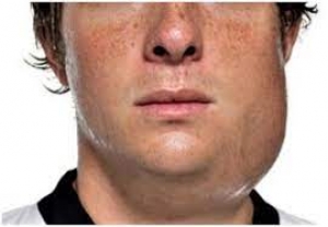 Untreated mumps infection can cause infertility in men, physician warns