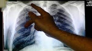 TB deaths rise first time in more than a decade due to COVID-19