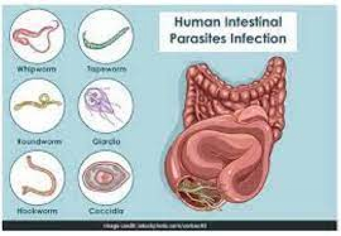 Not deworming can cause malnutrition, intestinal perforation, death –Paediatricians ..Say 1.5 billion people currently estimated to be at risk