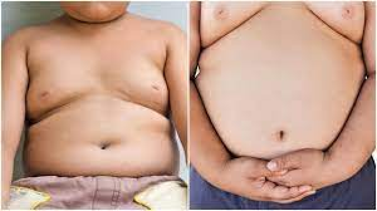 Obese children coming down with Type 2 diabetes, hypertension –Expert