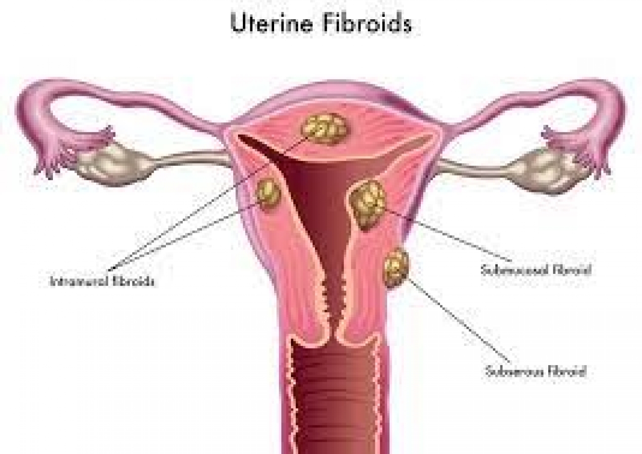 How to prevent death from fibroids –Expert