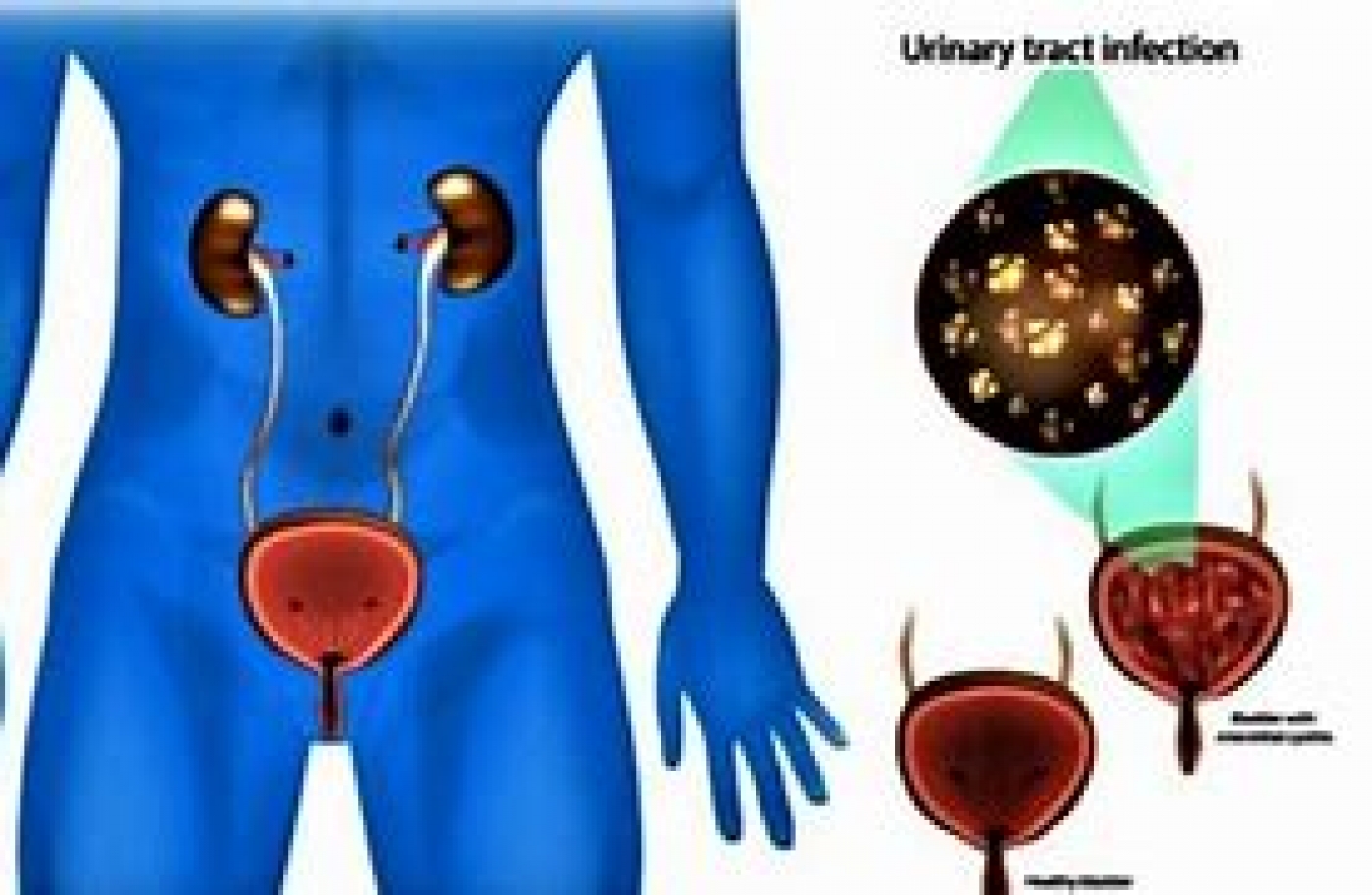 Why more older men are suffering from urinary tract infections –Expert